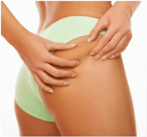 a woman checks whether she has cellulite