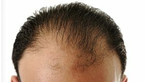 male pattern baldness