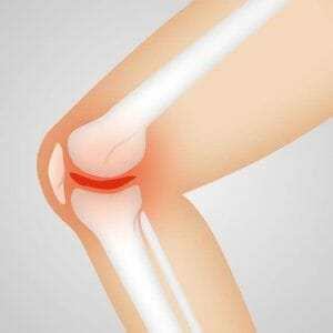 Painful knee joint