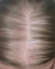 baldness in women