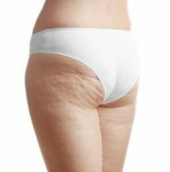 thighs and buttocks where cellulite is visible