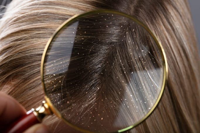 dandruff under a magnifying glass