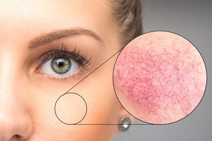 close-up of broken capillaries on the face