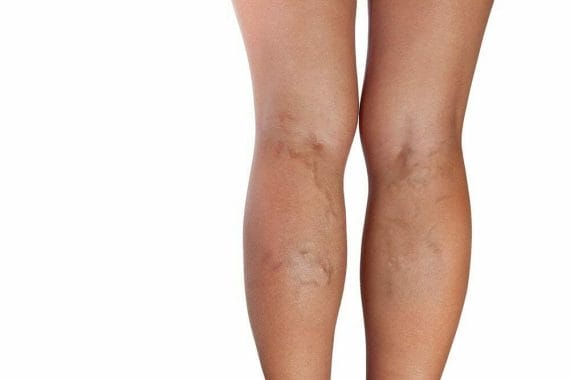  Varicose veins on calves