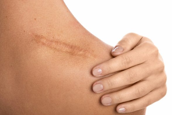 scar on the back