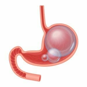 graphic showing bloated stomach and intestines
