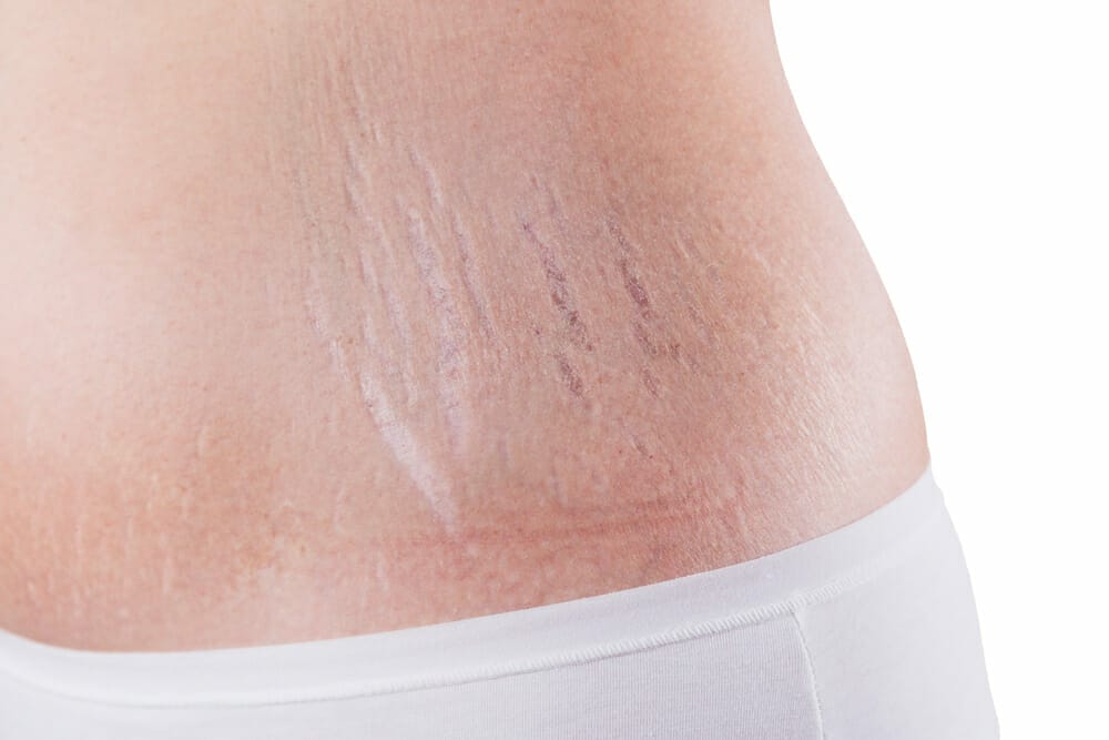  Stretch marks on the abdomen