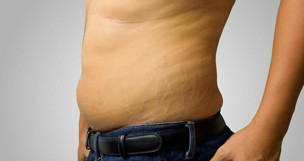 Man with stretch marks on the abdomen