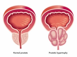  prostate gland hypertrophy