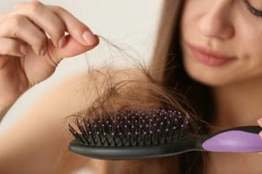  hair loss in a woman